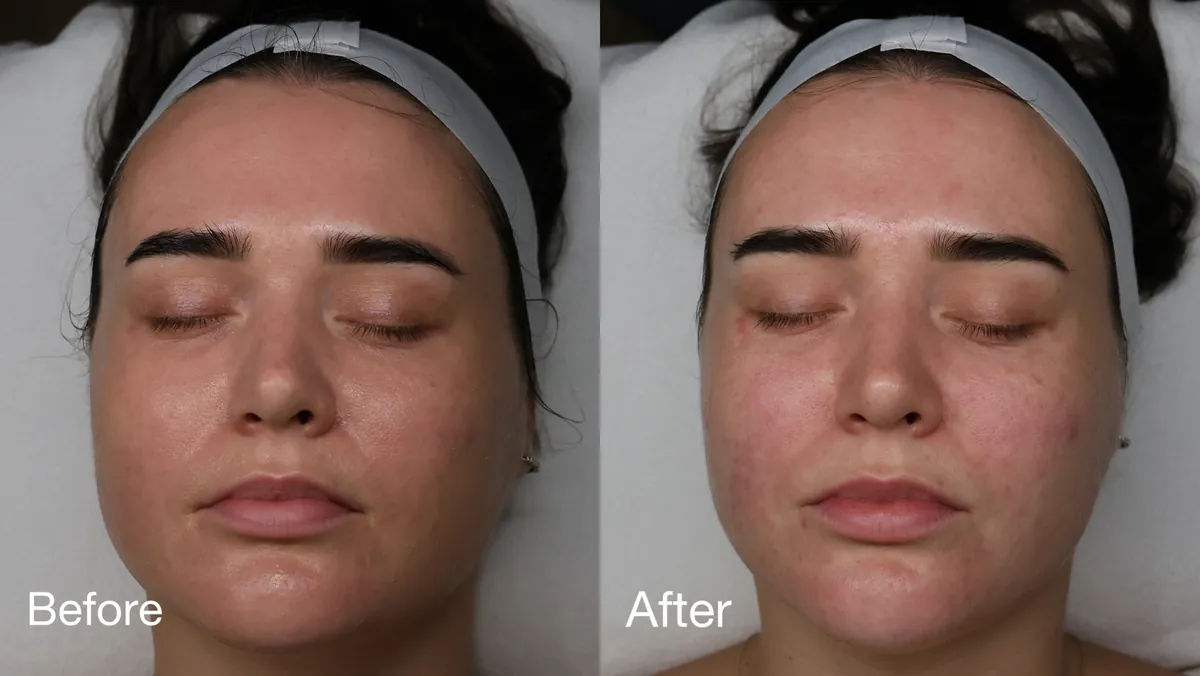Facial Treatment