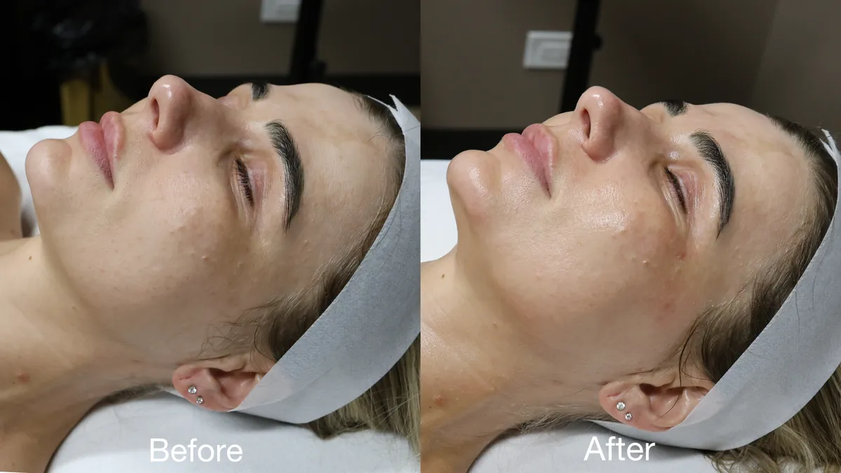 Facial Glow Treatment