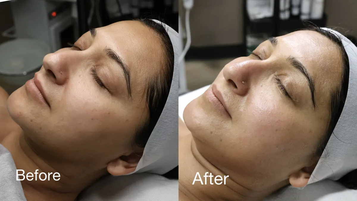 Facial Rejuvenation