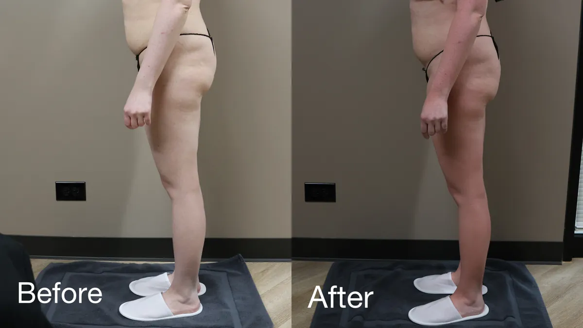 Body Contouring