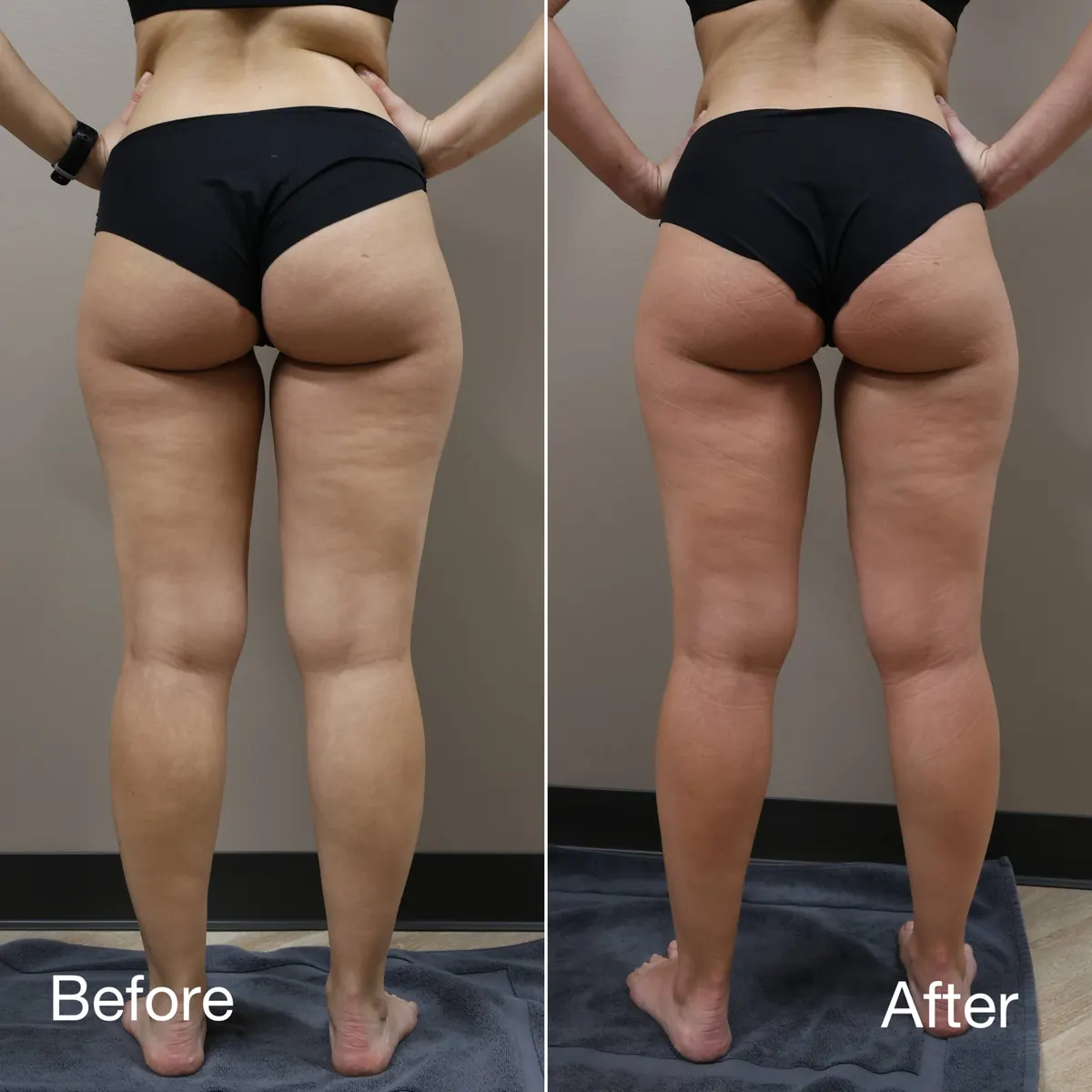 Before & After — Body Contouring