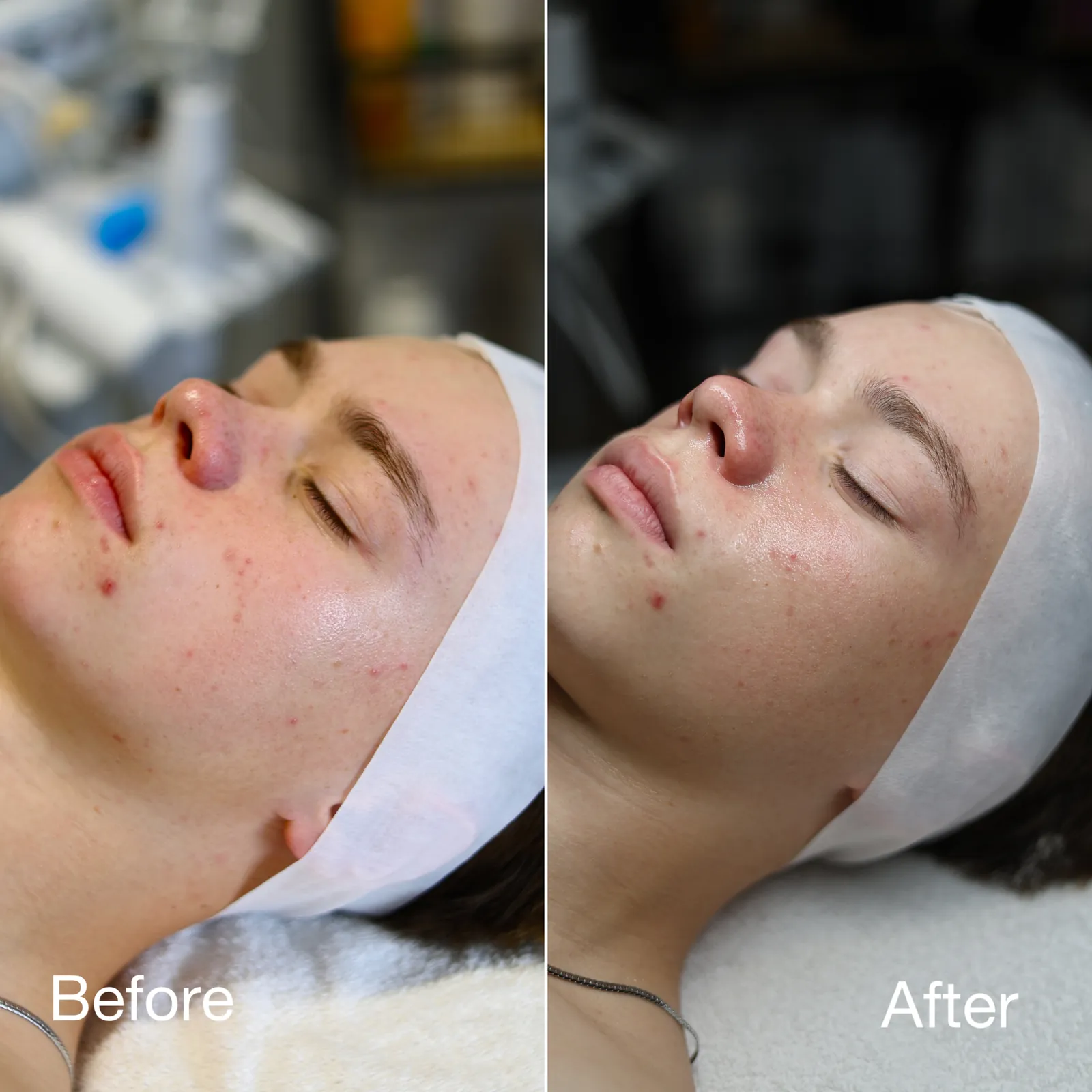 Before & After — Facial Treatment