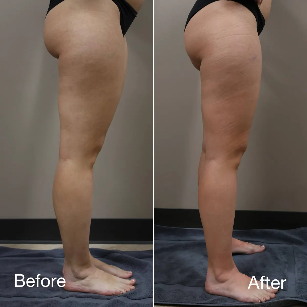Before & After — Body Slimming Legs